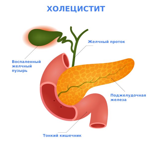 холецистит